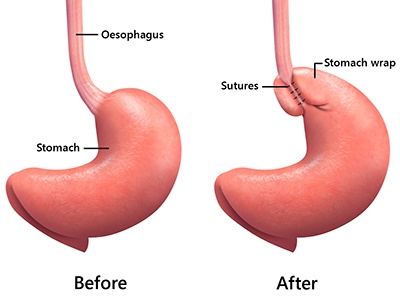Gastro Oesophageal Reflux Surgery